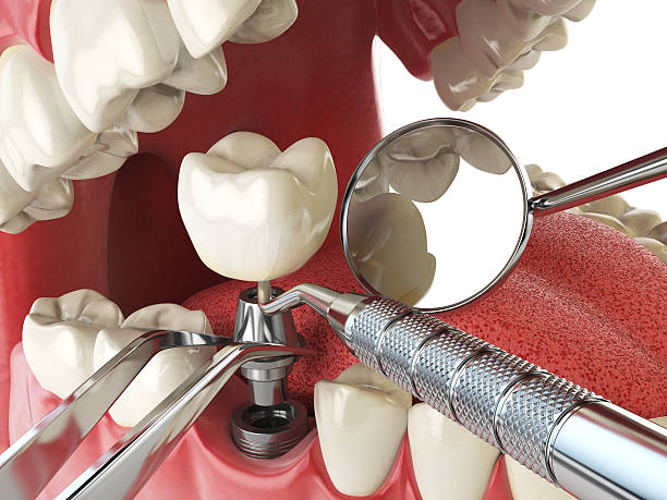 Best Emergency Wisdom Tooth Extraction in Golden Hills, CA
